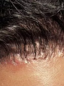 hair transplant nightmares